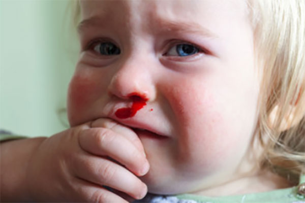 У девочки идет кровь из носа