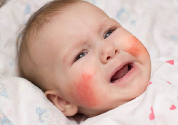 Девочка с красными щеками плачет