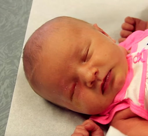 Грудничок с бактериальным конъюнктивитом