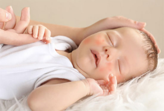 Спит грудной ребенок. На щечках характерные пятна