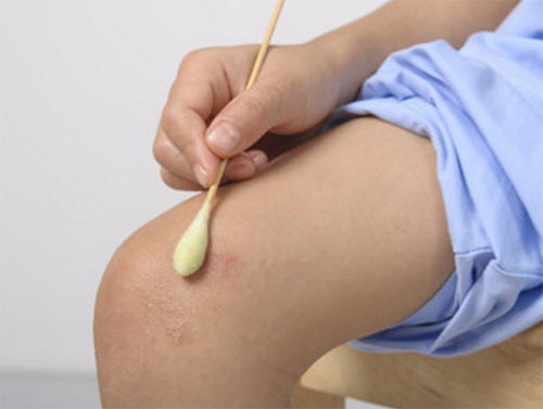 Мальчик обрабатывает средством нанесенным на ватную палочку пораженный участок на ноге