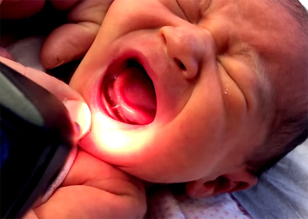 Грудному ребенку светят на короткую уздечку