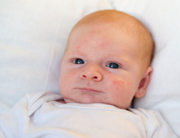 Грудной ребенок с аллергической сыпью на щеках