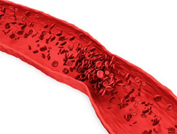 Схематическое изображение тромбоза (поперечный разрез сосуда)