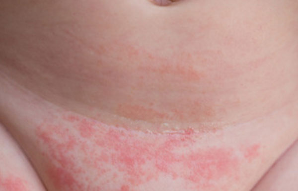 Пах грудного ребенка с характерной сыпью