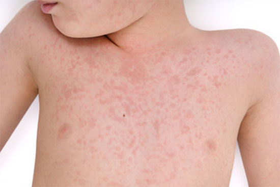 Характерная сыпь на грудной клетке ребенка