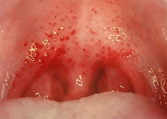 Снимок горла с характерной сыпью и покраснением