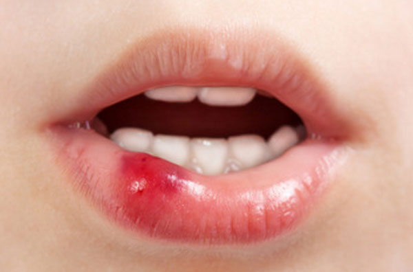 Губы ребенка с покраснением и припухлостью