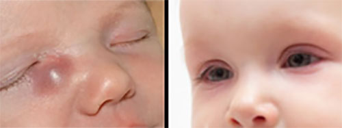 Фото ребенка с дакриоциститом и малыша в коньюнктивитом