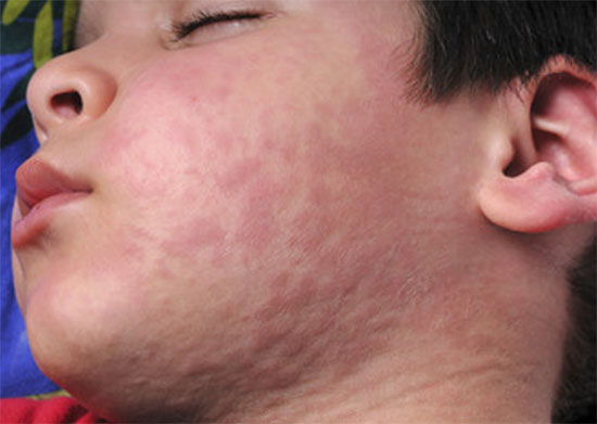 Лицо и шея мальчика с ярко выраженной крапивницей