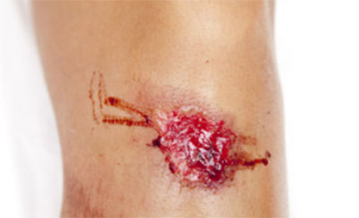 Кровоточащая рана