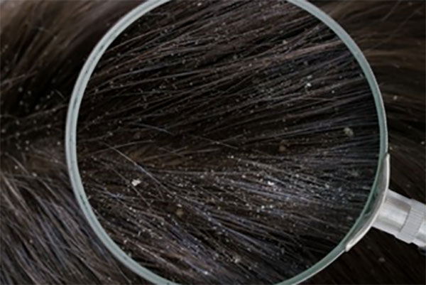 Волосы с перхотью и увеличение под лупой