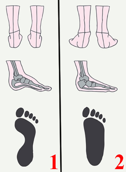 Схематическое изображение нормальной стопы и плоскостопия. Показан вид сзади, сбоку (видны кости) и отпечаток