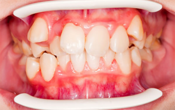 У ребенка неправильный прикус