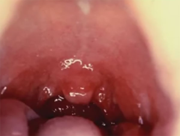 Воспаленное горло