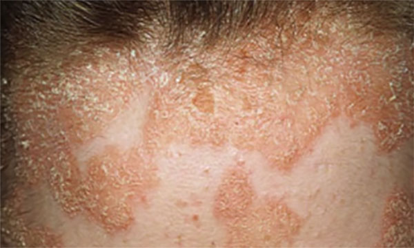 Фотография псориаза волосистой части головы