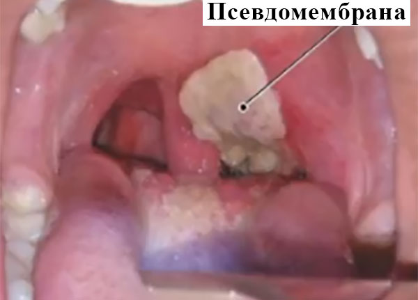 Горло ребенка с образовавшейся псевдомембраной
