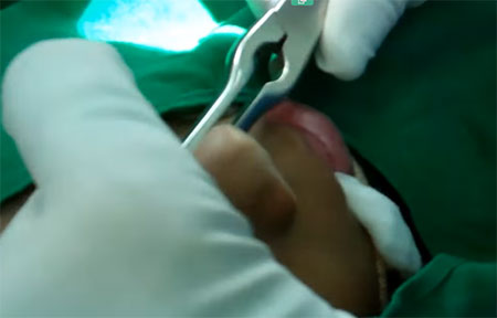 Хирургическое лечение перелома носика