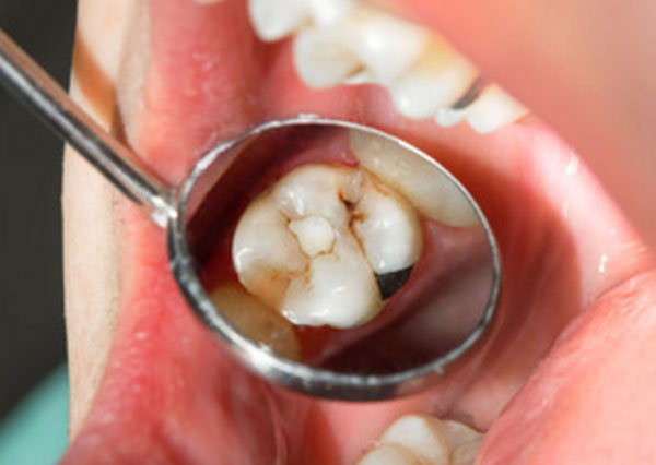Зуб с кариесом