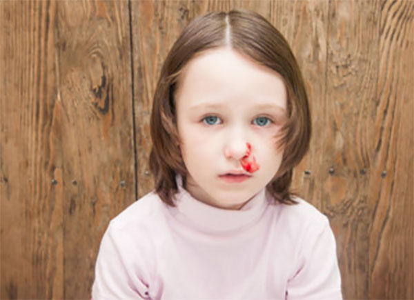 Девочка с носовым кровотечением