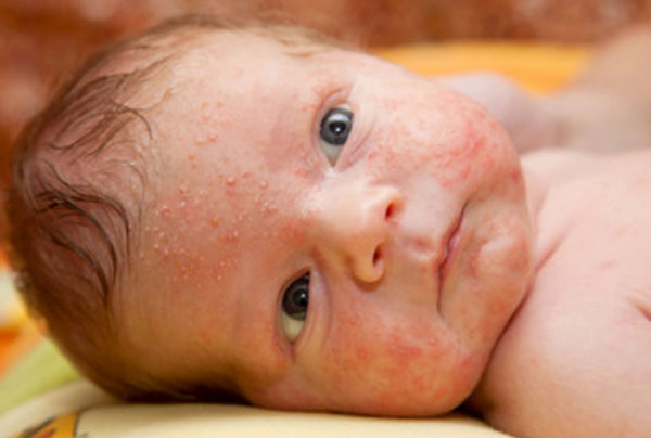 Характерная сыпь на лице грудничка
