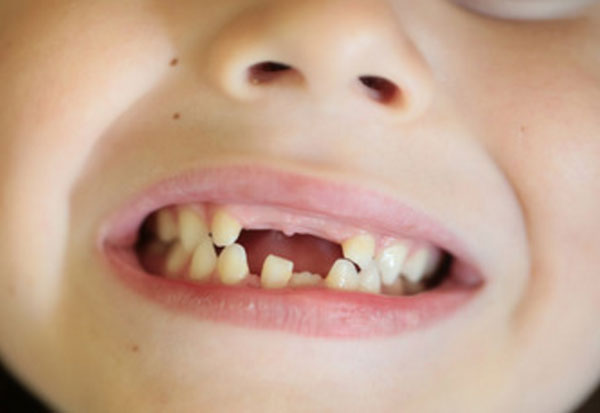 Ребенок улыбается. Во рту не хватает зубов