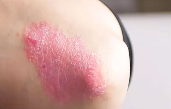 Локоть ребенка с псориатическим артритом