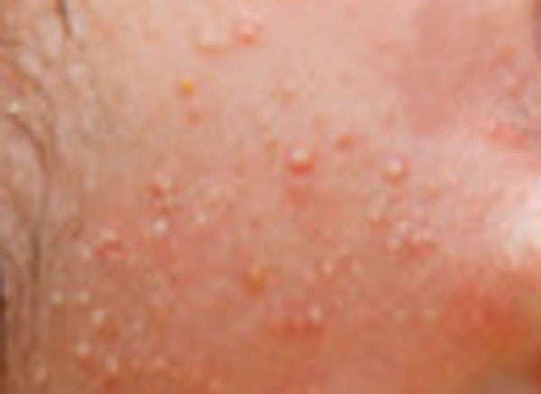 Сыпь на лобике