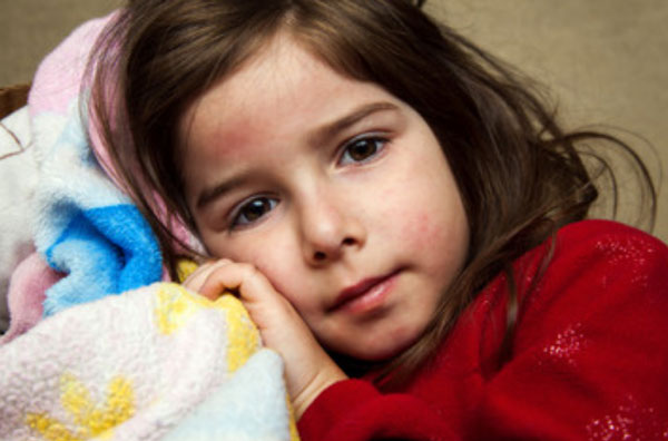 Девочка с сыпью на лице