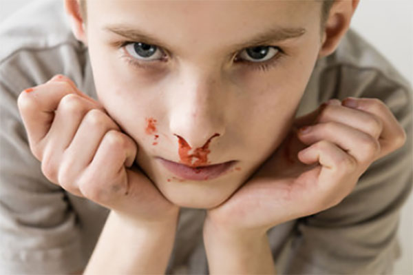 Мальчик с носовым кровотечением сидит с наклоненной головой вперед