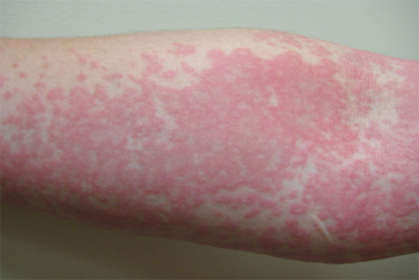 Рука, пораженная аллергией на солнце