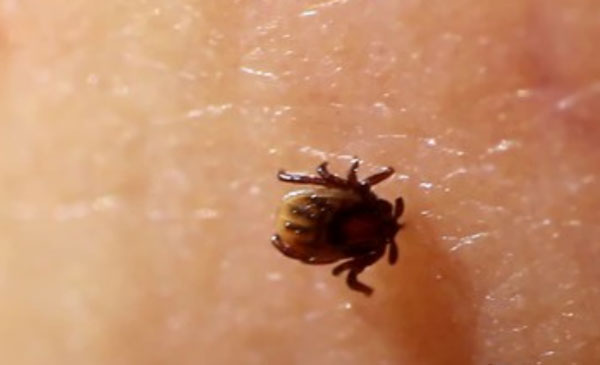 Клещ сидит на коже