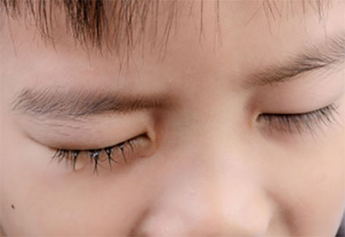 У ребенка слезится один глаз