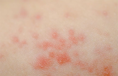 Кожа ребенка с красными пятнами