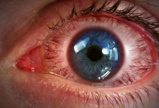 Сильно воспаленный глаз