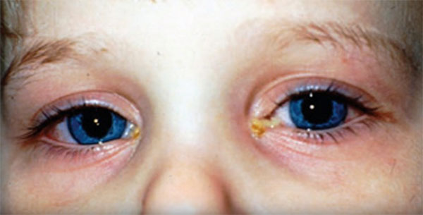 Ребенок с гнойными выделениями из глаз