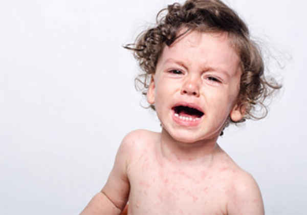 Ребенок с проявлениями кори плачет