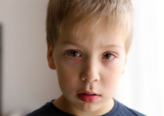 Мальчик с бактериальным конъюнктивитом