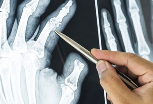 Рентген кисти руки