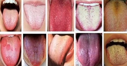 10 языков с различными высыпаниями