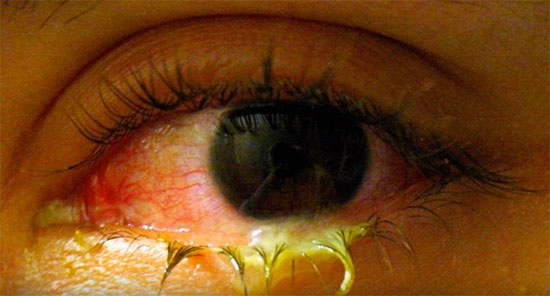 Бактериальный конъюктивит