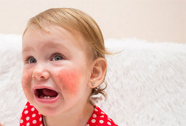 Девочка с красными щеками собирается заплакать