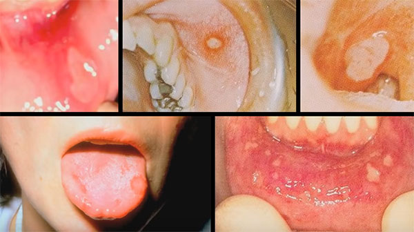 Фотографии с разными проявлениями афтозного стоматита