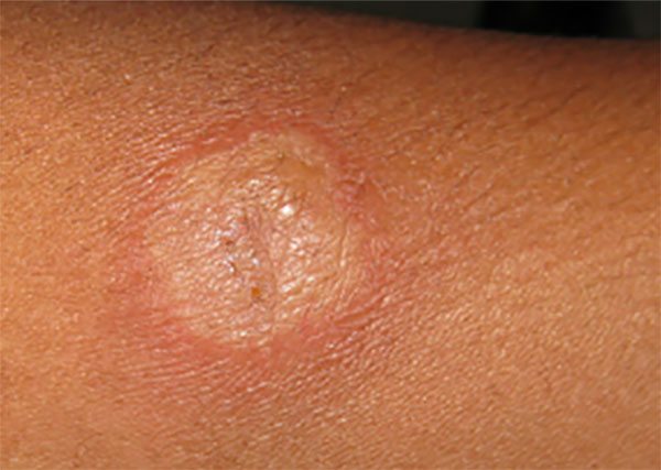 Положительная проба манту