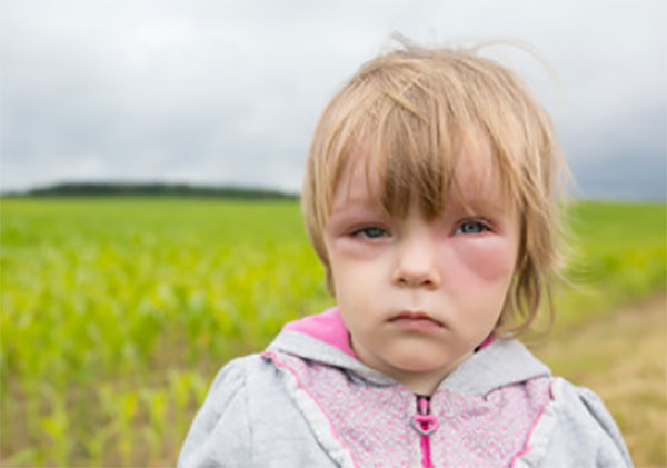 Девочка с отеком Квинке