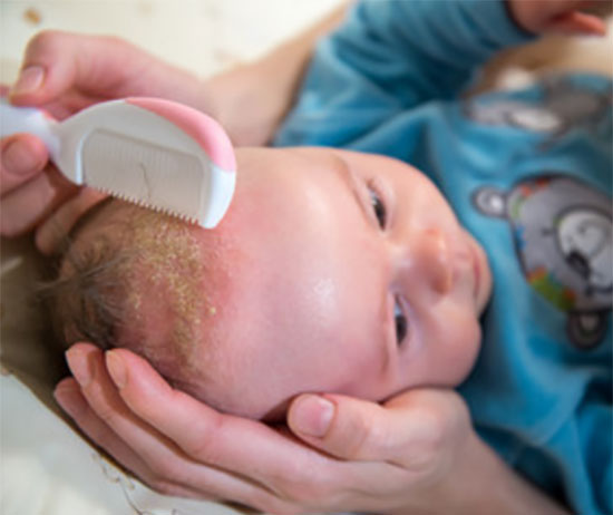 Малышу вычесывают корочки