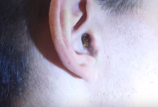 Ухо ребенка с серной пробкой