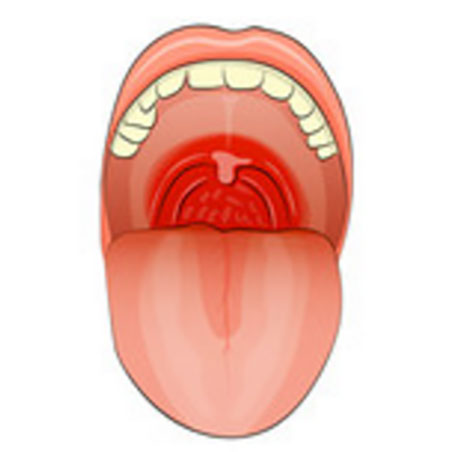 Рисунок горла с признаками фарингита