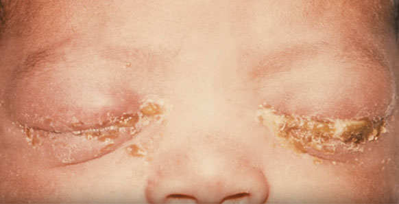 Закисли глазки у ребенка, покрылись корочками