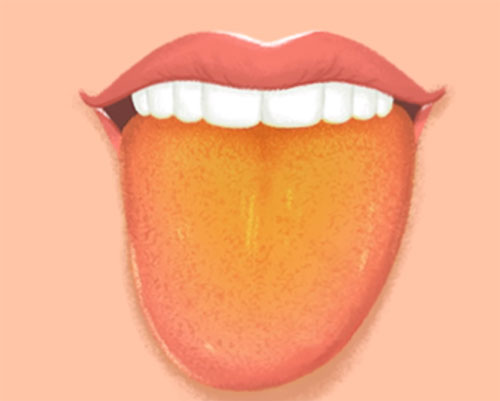 Желтый налет на языке